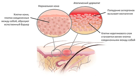 Атопический дерматит