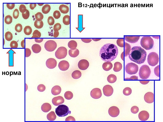 B12 анемия