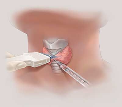 Биопсия щитовидной железы