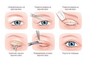 Блефаропластика нижніх повік