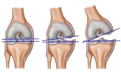 Повреждение связок коленного сустава