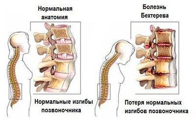 Болезнь Бехтерева