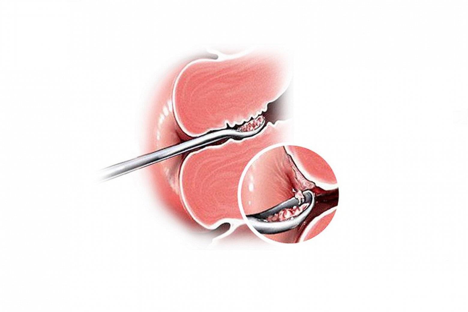 Выскабливание зачем. Выскабливание цервикального канала шейки. Хирургическое выскабливание полости матки. Бужирование цервикального канала. Инструменты для бужирования цервикального канала.