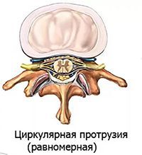 Циркулярная грыжа диска