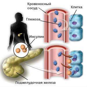 Сахарный диабет