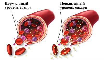 Сахарный диабет