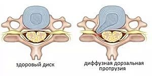 Диффузная грыжа диска