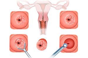 Дисплазия шейтки матки