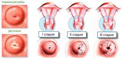 Стадии дисплазии шейтки матки