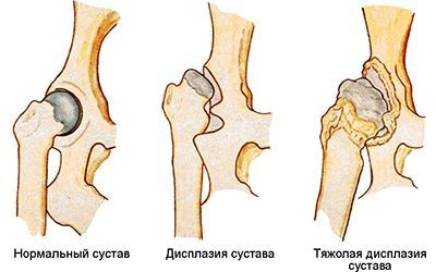 Реферат: Дисплазия тазобедренного сустава