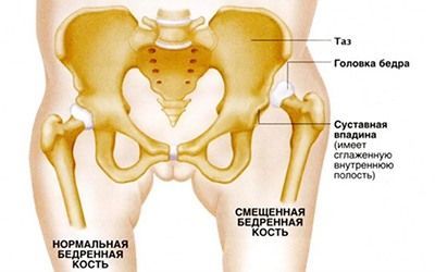 Дисплазия тазобедренных суставов