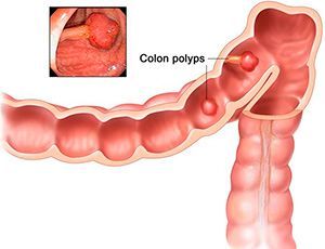 Доброкачественные опухоли толстой кишки