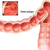 Доброкачественные опухоли толстой кишки