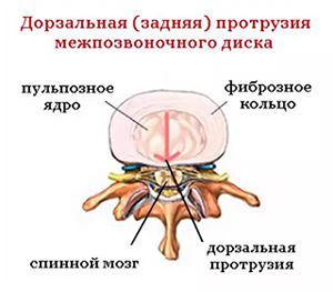 Дорзальная грыжа диска