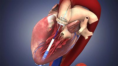 Эндоваскулярное протезирование аортального клапана