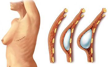 Эндопротезирование молочных желез