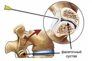 Фасетопластика