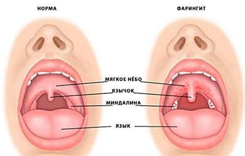Фарингит