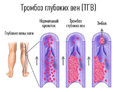 Тромбоз глубоких вен