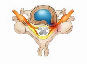 Фораминальная грыжа диска