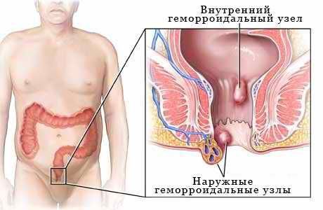 лечение геморроя