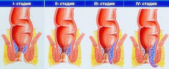 стадии геморроя