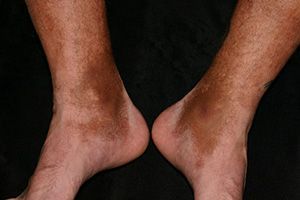 Гемосидероз болезнь шамберга геморрагическая сыпь на ногах thumbnail
