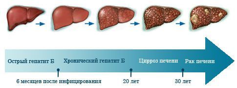 Стадии развития болезни