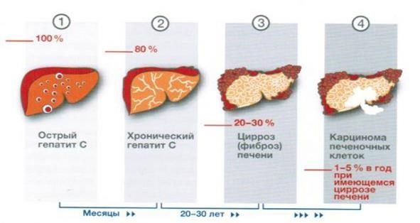 Стадии развития болезни