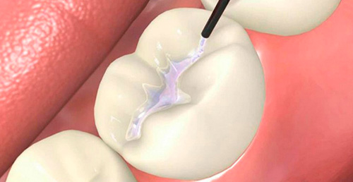 Как выглядит герметизация фиссур