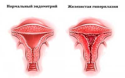 Гиперпластические процессы