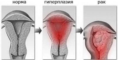 Гиперплазия эндометрия