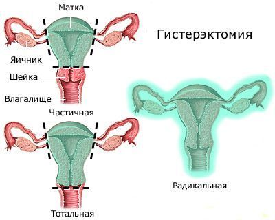 субтотальная гистерэктомия