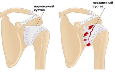 Плечелопаточный периартроз