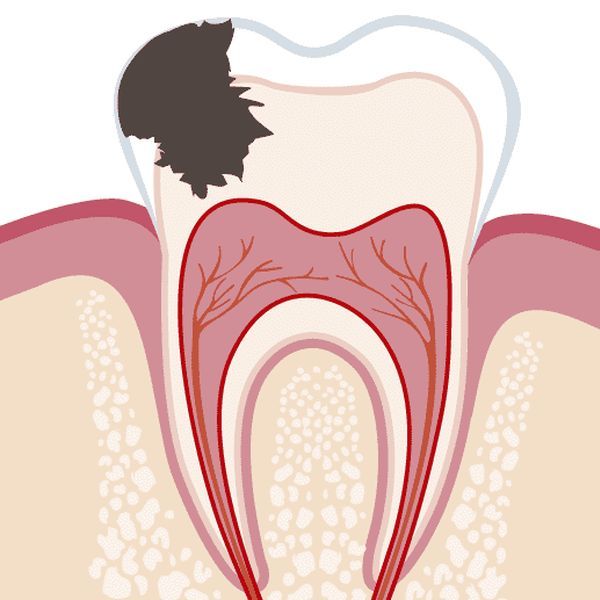Глубокий кариес