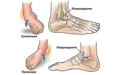 Повреждения голеностопного сустава