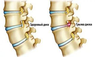 Грыжа диска поясничного отдела