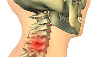 Грыжа диска шейного отдела