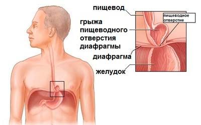 Грыжа Под Фото