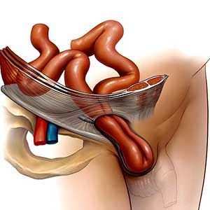 Грыжи паховые