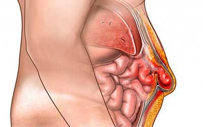 Признаки грыжи передней брюшной стенки