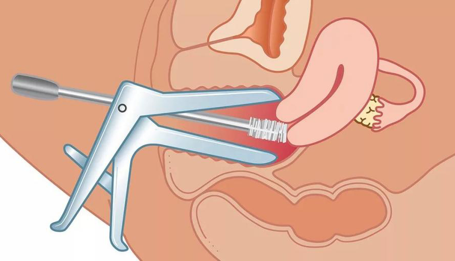 Взятие гинекологических соскобов