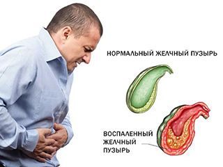 боли при воспаление желчного пузыря симптомы