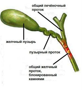 Холедохолитиаз