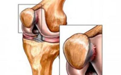 Хондромаляция коленного сустава