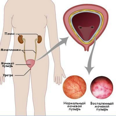 Цистит: ответы на частые вопросы пациентов