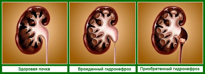 Гидронефроз почки