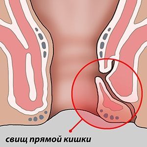 Иссечение свища прямой кишки, сфинктеропластика