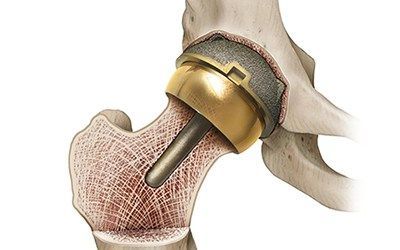 Эндопротезирование тазобедренного сустава