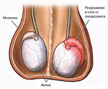 Если опухла головка придатка яичка thumbnail